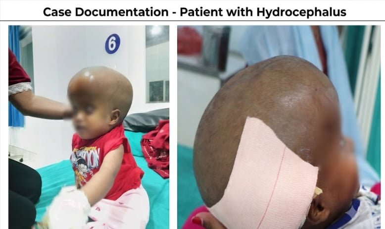 संजीवनी शिक्षण अस्पतालमा जटिल न्यूरो सल्यक्रिया सफल, तीन वर्षीया बालिकाले पाइन् नयाँ जीवन